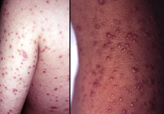 Nhiễm nấm Histoplasma - Hình ảnh minh họa